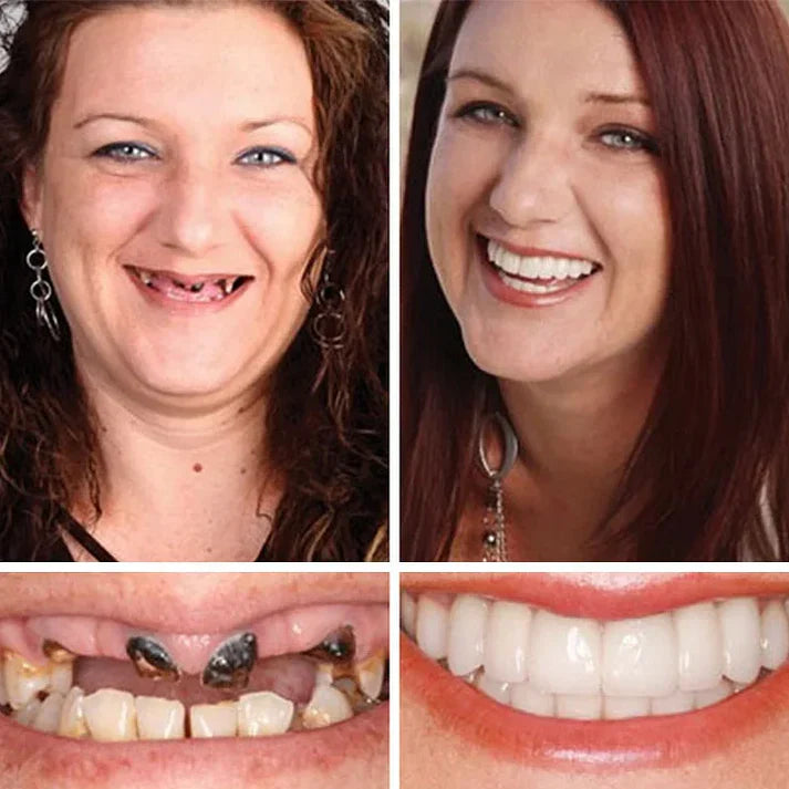 🌎Ends Today: 70% OFF! ⏰ Custom-Fit Full Functional Dentures Make you more confident